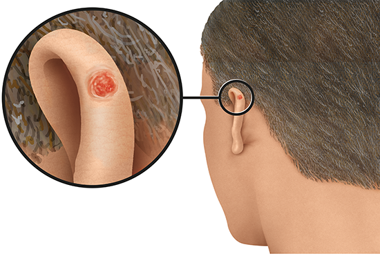 Grafik: Wie weißer Hautkrebs am Ohr auf heller Haut aussehen kann 