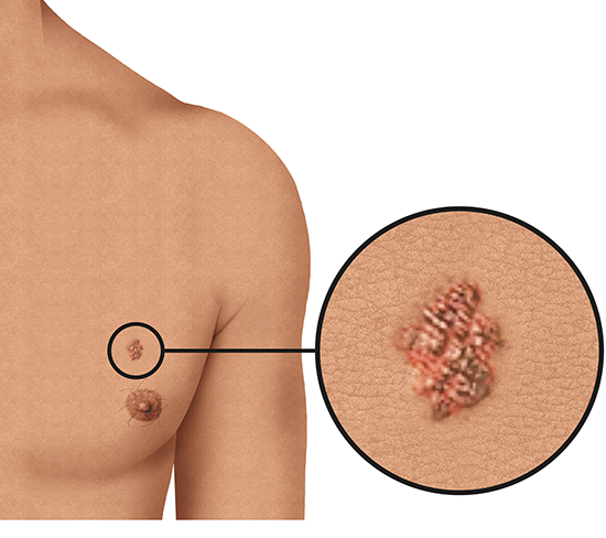 Grafik: Schwarzer Hautkrebs auf der Brust bei heller Haut