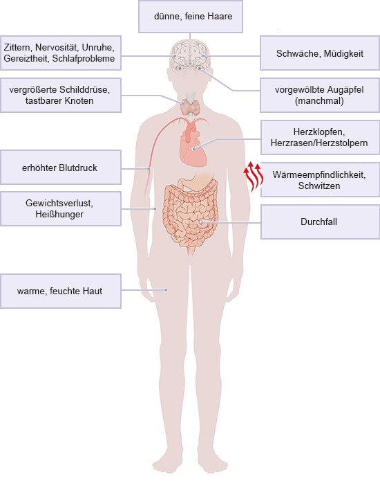 Grafik: Mögliche Symptome einer Schilddrüsenüberfunktion