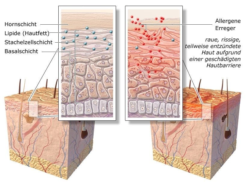 Grafik: Gesunde Haut und Haut mit Neurodermitis - wie im Text beschrieben