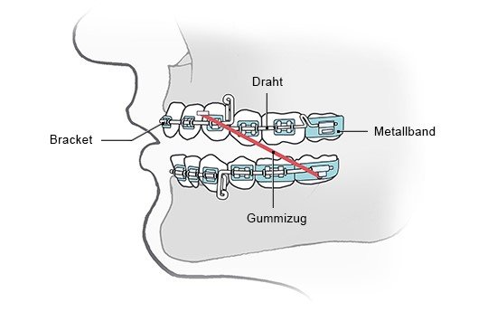 Grafik: Eine festsitzende Zahnspange mit aufgeklebten Brackets