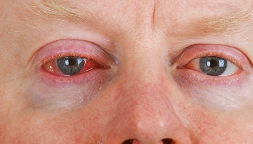 Foto eines Mannes mit stark gerötetem Auge