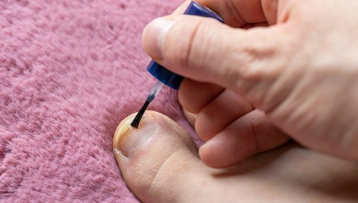 Foto von einem großen Zeh mit Nagelpilz, der mit medizinischem Nagellack behandelt wird