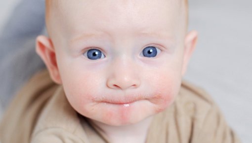 Foto von Kleinkind mit Neurodermitis im Gesicht