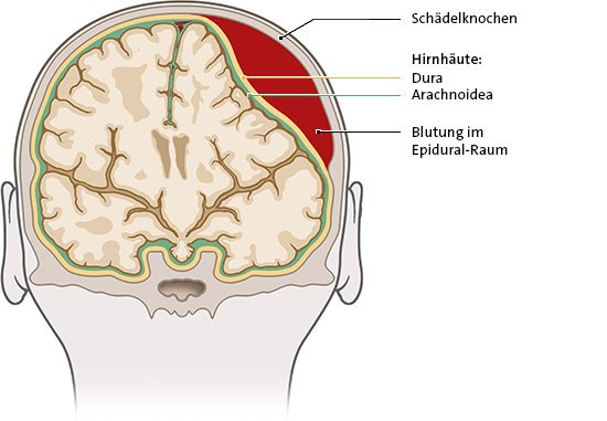 Die Grafik zeigt eine epidurale Blutung. Dabei blutet es zwischen Schädelknochen und harter Hirnhaut.