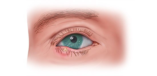 Die fotorealistische Grafik zeigt ein Gerstenkorn am Unterlid.