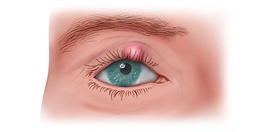 Die fotorealistische Grafik zeigt ein Hagelkorn am Oberlid.