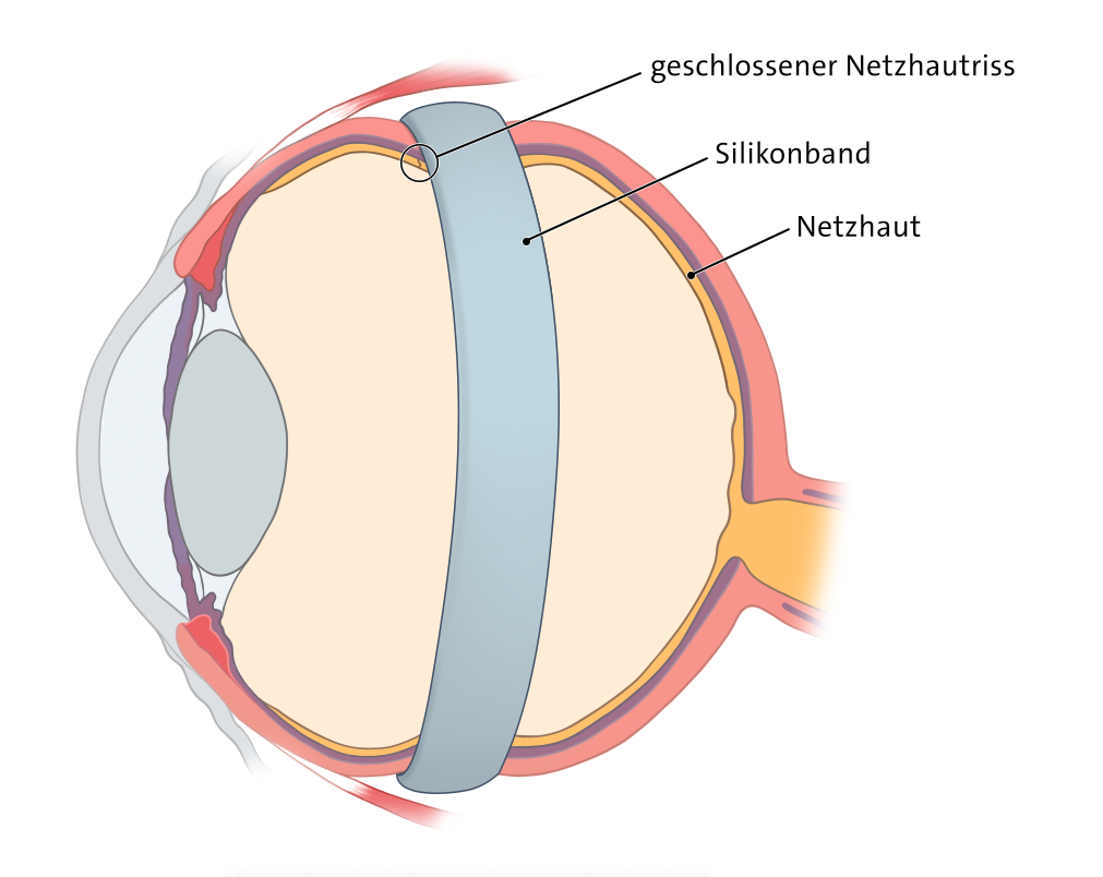 Grafik: Eindellende Operationsverfahren: Silikonband