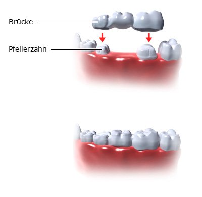 Die beiden fotorealistischen Grafiken zeigen, wie eine Brücke über zwei Pfeilerzähnen befestigt wird. 