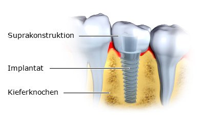 Die fotorealistische Grafik zeigt, wie ein Implantat mit aufgesetztem Zahnersatz (Suprakonstruktion) im Kieferknochen verankert ist.