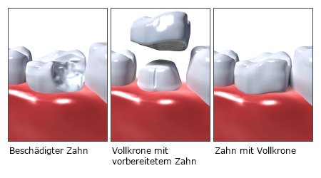 Die fotorealistischen Grafiken zeigen in drei Schritten, wie eine Vollkrone auf einen vorbereiteten beschädigten Zahn aufgesetzt wird.