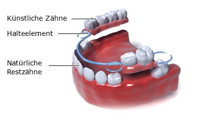 Die fotorealistische Grafik zeigt, wie eine Teilprothese für den Unterkiefer mittels Halteelementen an den natürlichen Restzähnen befestigt wird. 