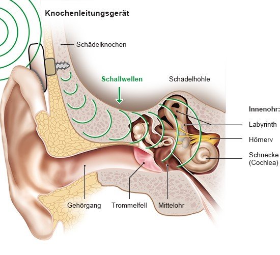 Grafik: Knochenleitungshörgerät mit implantierter Schraube