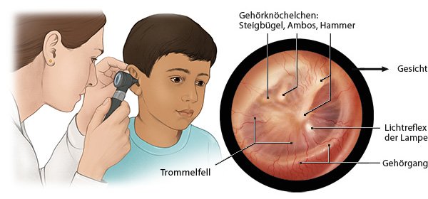 Die Grafik zeigt links eine Ärztin bei der Ohrspiegelung bei einem Kind und rechts das Trommelfell in Detailansicht.
