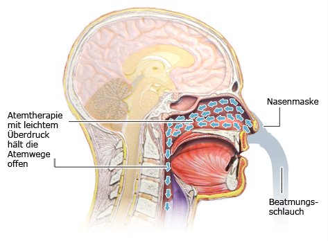 Die vereinfachte anatomische Grafik zeigt, wie eine CPAP-Atemtherapie die Atemwege offen hält. 