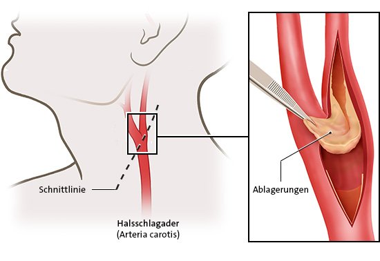 Die Grafik zeigt eine Karotis-Endarteriektomie: links die Stelle am Hals für den Hautschnitt und rechts in Detailansicht, wie Ablagerungen entfernt werden.