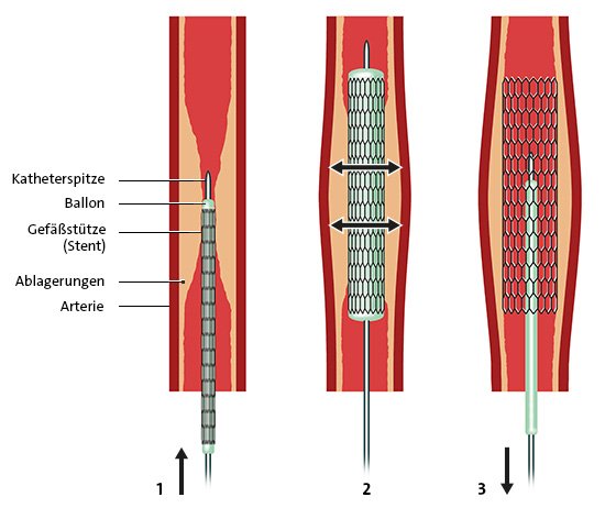 Die Grafik zeigt das Einsetzen des Karotis-Stents: Ablagerungen werden per Katheter an die Gefäßwand gedrückt, dann wird der Stent eingebracht.
