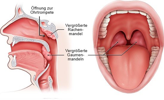 Lage der Mandeln. Links: Querschnitt Kopf seitlich, rechts: Blick in den Mund