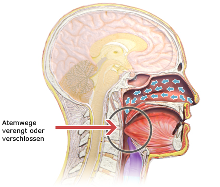 Die vereinfachte anatomische Grafik zeigt die Verengung der Atemwege bei einer obstruktiven Schlafapnoe.