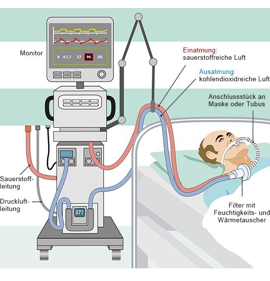 Die Grafik zeigt, wie ein Beatmungsgerät im Krankenhaus über Schläuche Luft in die Lunge pumpt. Am Gerät kann die Beatmung geregelt werden.