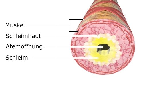 Die Grafik zeigt einen Atemweg im Querschnitt, der durch eine zähe Schleimschicht verengt ist.