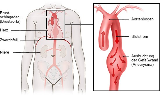 Brustschlagader und Ausbuchtung der Gefäßwand (Aneurysma)