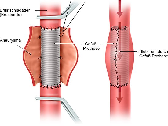 Die Grafik zeigt links das geöffnete Aneurysma mit eingesetzter Gefäß-Prothese und rechts, wie das Blut danach durch die Prothese strömt.