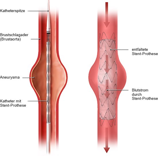 Die Grafik zeigt links, wie die Stent-Prothese in das Aneurysma eingesetzt wird und rechts, wie das Blut durch die Prothese strömt.