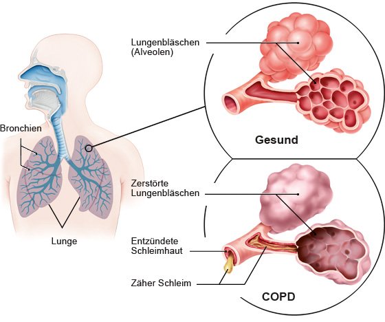 Die Grafik zeigt links die Lunge mit den Bronchien und rechts oben vergrößert gesunde Lungenbläschen und darunter zerstörte Lungenbläschen.
