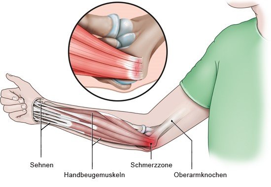Die Grafik zeigt die Innenseite des Ellenbogens – die Schmerzregion bei Golferarm –, und im Detail den Ansatz der Muskelsehnen am Ellenbogen.