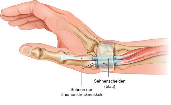 Die anatomische Grafik zeigt in Seitansicht, wie Sehnen des Daumenstreckmuskels von Bindegewebshüllen, den Sehnenscheiden, geschützt werden.