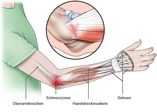 Die Grafik zeigt die Außenseite des Ellenbogens – die Schmerzregion bei Tennisarm –, und im Detail den Ansatz der Muskelsehnen am Ellenbogen.
