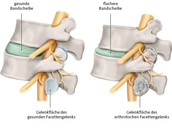 Facettengelenk in der Lendenwirbelsäule, links: ohne Arthrose, rechts: mit Arthrose