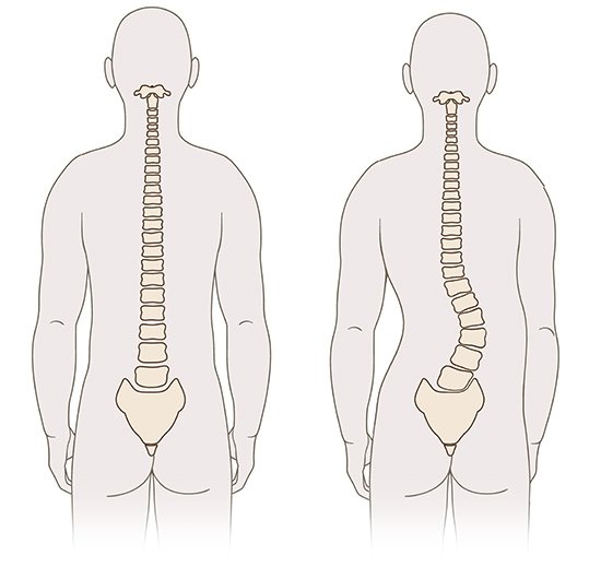 Die Grafik zeigt die schematische anatomische Darstellung einer gesunden Lendenwirbelsäule (links) und einer Lendenwirbelsäule mit Skoliose (rechts).