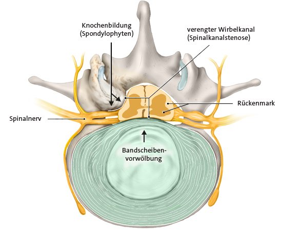 Verengung des Spinalkanals, Querschnitt, Ansicht von oben