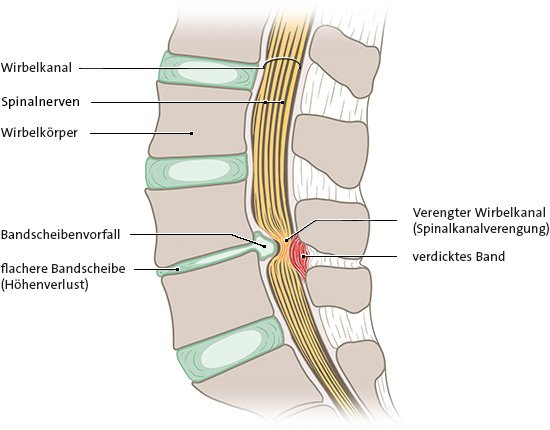 Verengung des Spinalkanals, Längsschnitt, Ansicht von der Seite