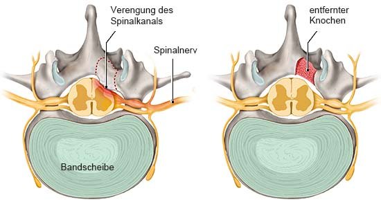 Die linke Grafik zeigt die Bandscheibe mit verengtem Spinalkanal, die rechte den bei der Dekompression entfernten Knochen.