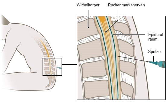 Die Grafik zeigt, wie eine wirbelsäulennahe Kortisonspritze in den Epiduralraum gesetzt wird.