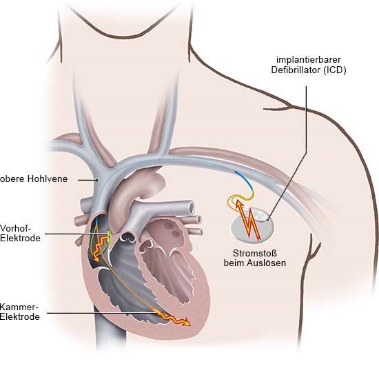 Grafik: Ein ICD-Gerät gibt einen oder mehrere Stromstöße zur Normalisierung des Herzrhythmus ab