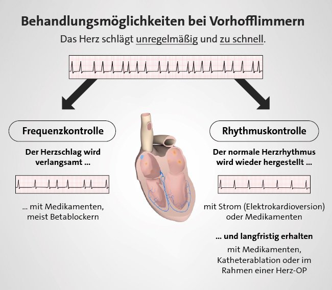 Grafik: Möglichkeiten, den Herzrhythmus bei Vorhofflimmern zu beeinflussen