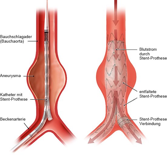 Die Grafik zeigt, wie ein Katheter mit Stent in die Beckenarterie eingeführt wird (links) und das Blut danach durch den Stent strömt (rechts).