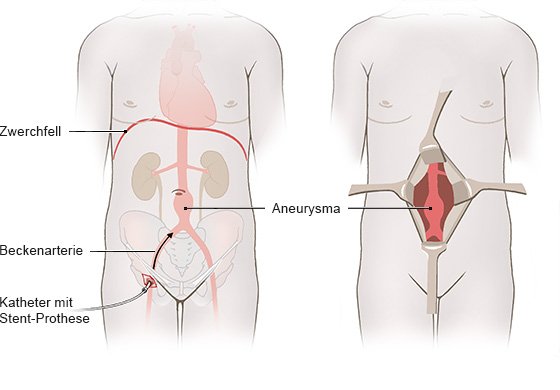 Die Grafik links zeigt den endovaskulären Eingriff über einen kleinen Schnitt in der Leiste und rechts die offene Operation über einen Bauchschnitt.