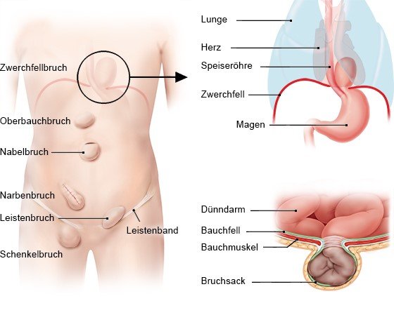 Die häufigsten Hernienarten