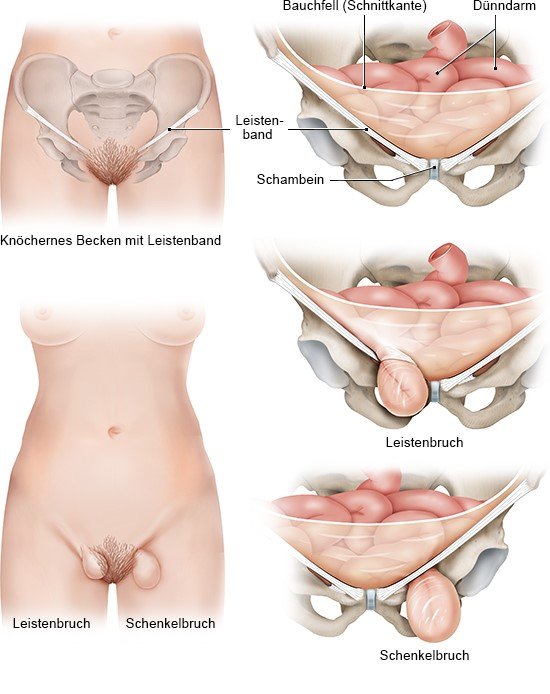 Grafik: Leisten- und Schenkelbruch bei Frauen - wie im Text beschrieben