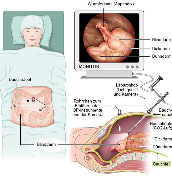 Die Grafik zeigt eine therapeutische Laparoskopie, bei der direkt operativ behandelt werden kann – hier am Beispiel der Blinddarmentzündung.