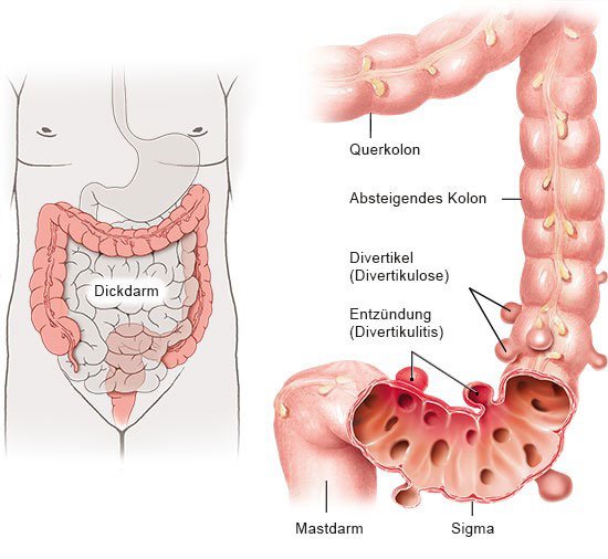 Die vereinfachte anatomische Grafik zeigt die Lage des Dickdarms im Körper (links) und das Sigma mit Divertikeln und Divertikulitis.