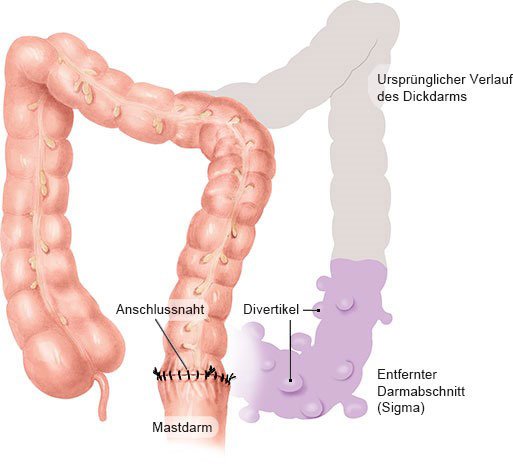 Die vereinfachte anatomische Grafik zeigt eine Sigma-Resektion, das häufigste Operationsverfahren bei chronischer Divertikelkrankheit