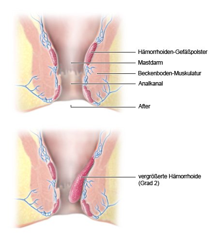 Die zweiteilige vereinfachte anatomische Grafik zeigt Hämorrhoiden-Gewebe im Längsschnitt. Im oberen Teil ist normales Gewebe zu sehen, der untere Teil der Grafik zeigt eine vergrößerte Hämorrhoide (Grad 2), die in den Analkanal ragt. 