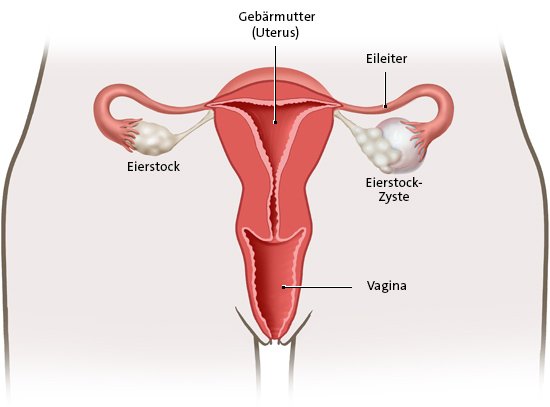 Die vereinfachte anatomische Grafik zeigt einen Eierstock mit Ovarialzyste (rechts)