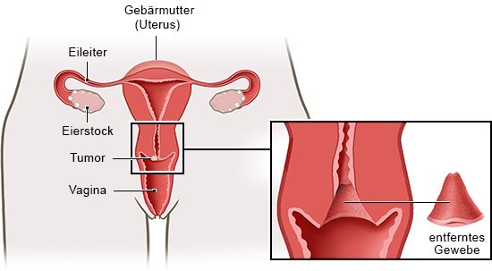 Die Grafik links zeigt die inneren Geschlechtsorgane und einen Tumor am Muttermund, die Grafik rechts den Muttermund nach der Gewebeentfernung.